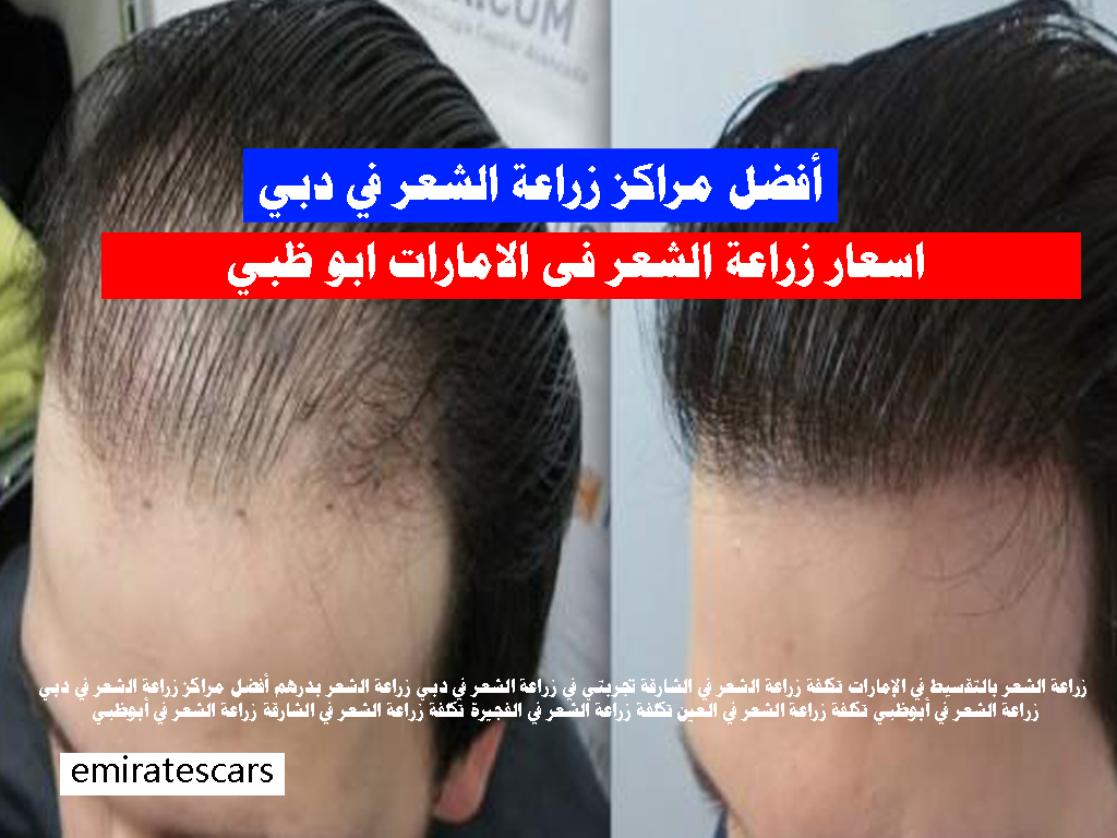 أفضل مراكز زراعة الشعر في دبي