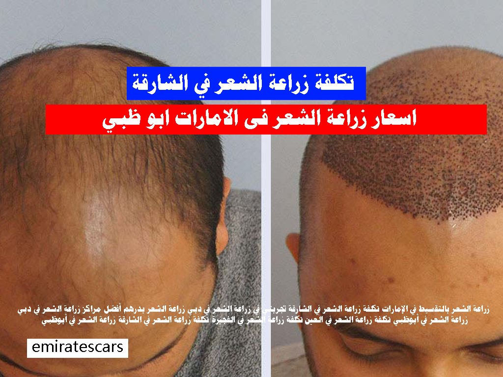 تكلفة زراعة الشعر في الشارقة زراعة الشعر في أبوظبي