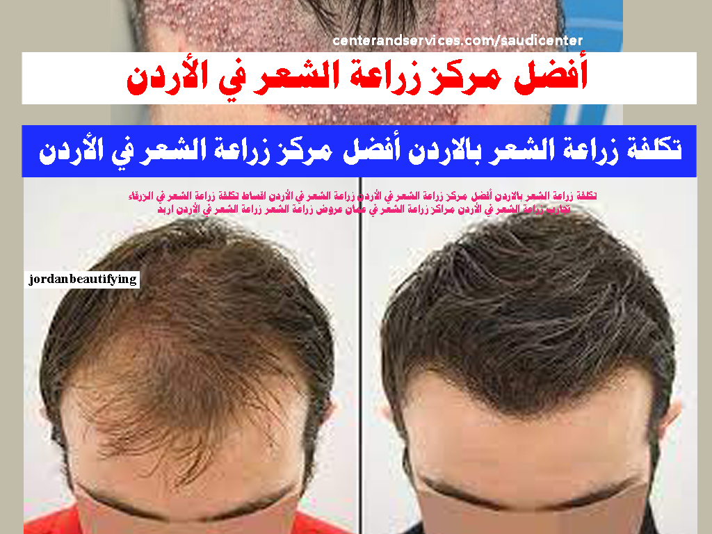 أفضل مركز زراعة الشعر في الأردن