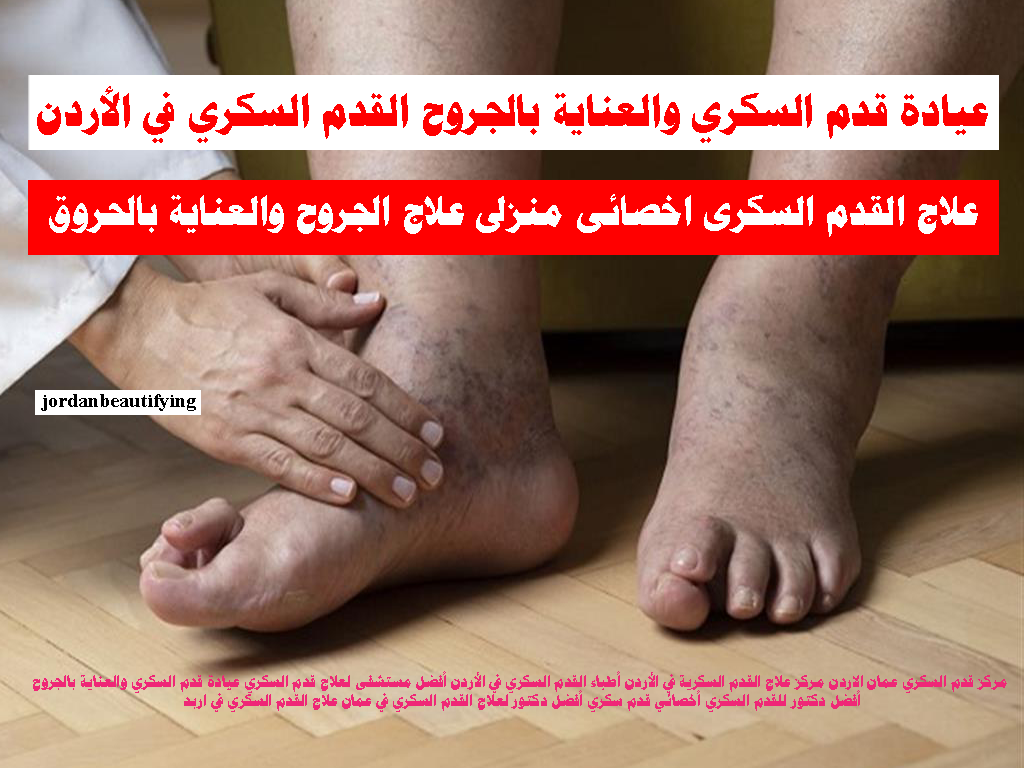 عيادة قدم السكري والعناية بالجروح القدم السكري في الأردن