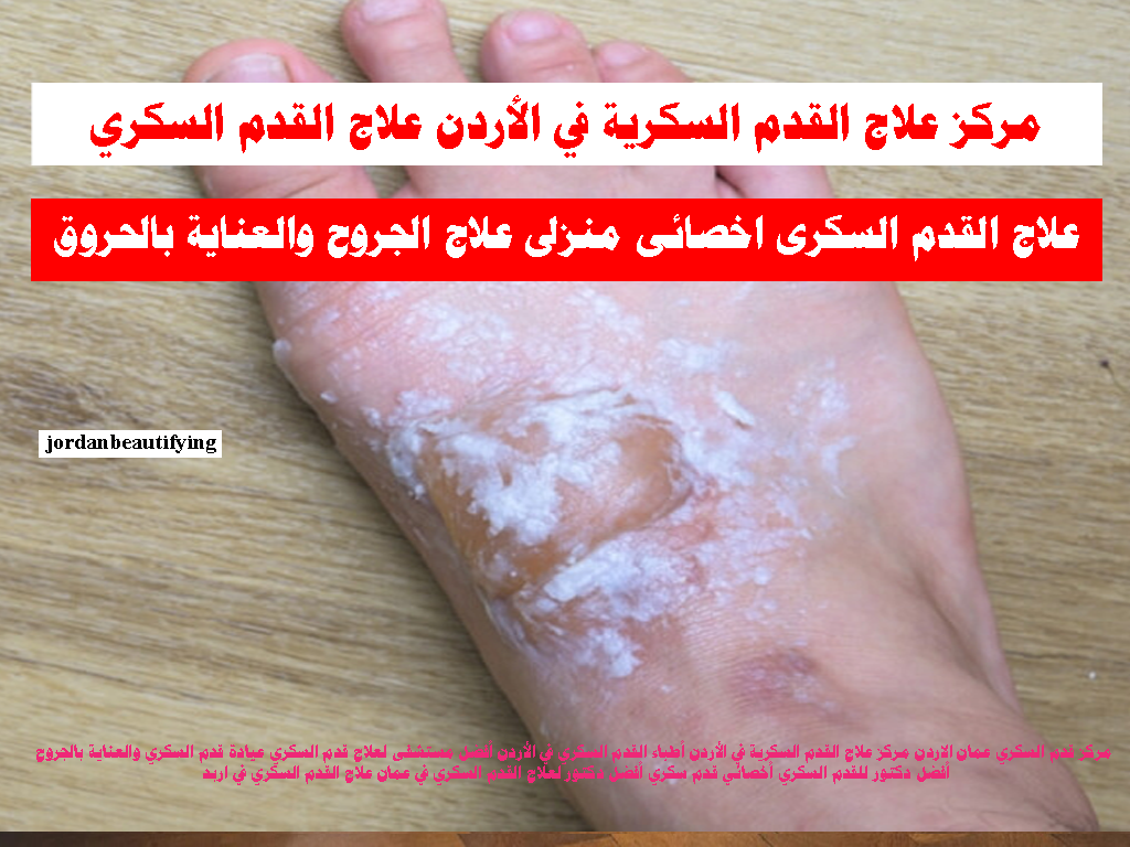 مركز علاج القدم السكرية في الأردن علاج القدم السكري