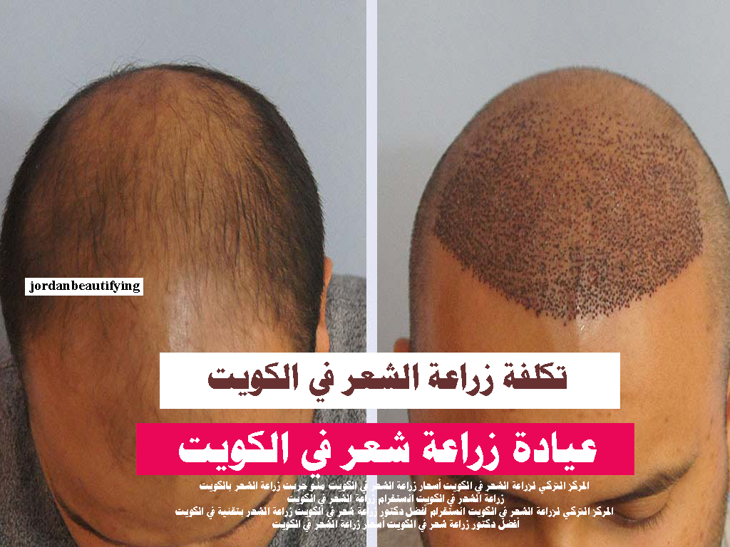 تكلفة زراعة الشعر في الكويت عيادة زراعة شعر في الكويت