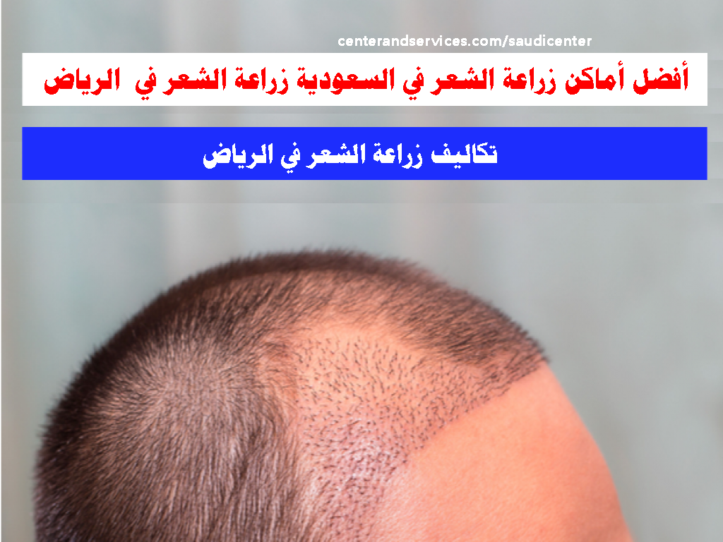 أفضل أماكن زراعة الشعر في السعودية زراعة الشعر في الرياض تكاليف زراعة الشعر الرياض